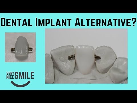 What is a monodont bridge?