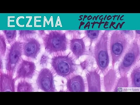 Eczema/Atopic, Contact Dermatitis, etc: Spongiotic Dermatitis Pattern - Inflammatory Dermpath Basics