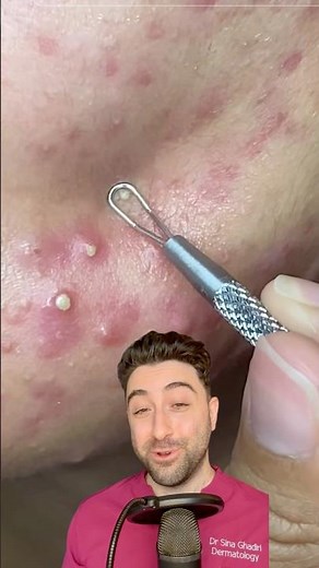 Is the COMEDONE EXTRACTOR the best tool for these PUSTULES?