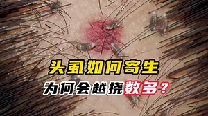 头虱如何悄然寄生？为何越挠数量反增？该如何防治？