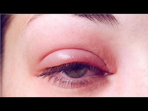 why is my upper eyelid swollen