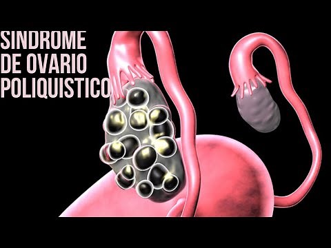 Sindrome de Ovario Poliquistico - ¿Que es? - Diagnostico - Complicaciones - Tratamientos