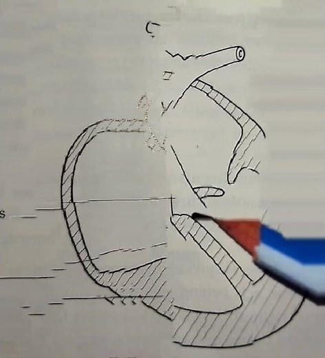 The tetralogy of Fallot