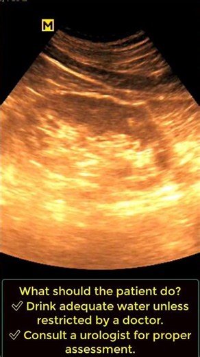 Large Kidney Stone Found on Ultrasound! One Stone is 1 58 cm