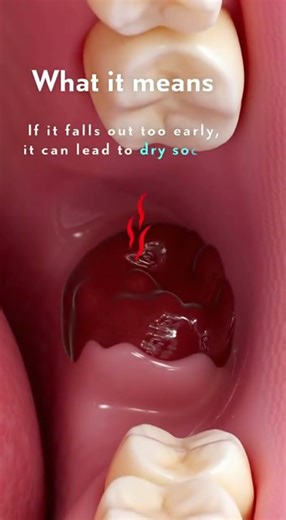 🦷 Did the Blood Clot Fall Out After a Tooth Extraction?