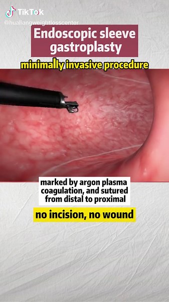 New #surgery which is no #wound no #incision #esg #endoscopicsleevegastroplasty #fyp #foryou #foryoupage #wls #weightlossmotivation #weightloss #loseweight #bariatricsurgery #workout #weightlosscommunity #hualiangweightlosscenter