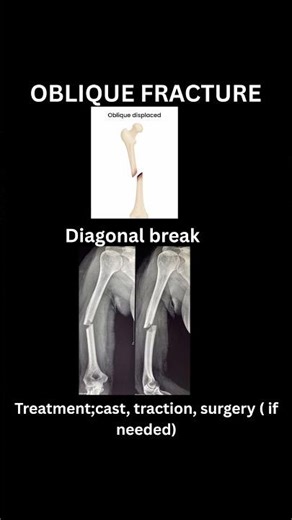 # fracture#types of fracture #fracture treatment#ortho fracture #fracture management#fracture risk#