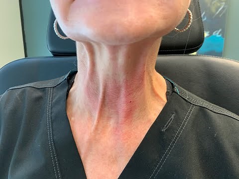 Injecting Botox in the Neck to relax neck bands