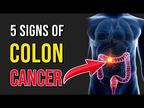 Signs Of Colon Cancer | Symptoms Of Colon Cancer and Treatment