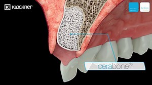 Immediate tissue augmentation technique with application of cerabone® and Jason® membrane