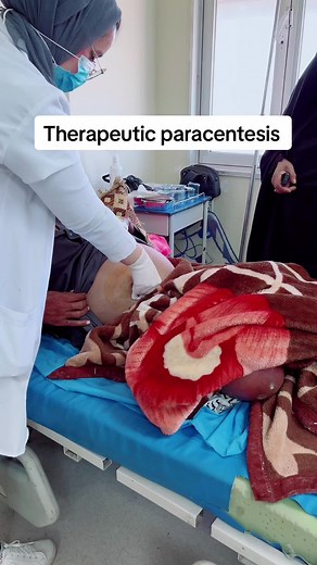 Therapeutic paracentesis #يوميات_طبيبة #مستشفيات #يومياتي #طالبة_طب #مستشفيات_الحكومة @Dr.hiba @Classic ladies