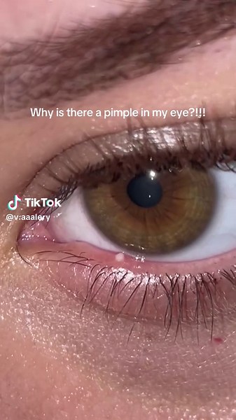 ¿Por qué tengo un grano en el ojo?