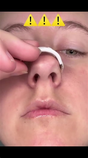 DREAM QUIET BURUN BANDINI SATIN ALMAK İÇİN SAYFAMIZDAKİ LİNKE TIKLAYIN. BURUN BANTLARI NE İŞE YARAR? Daha İyi Nefes Alma: Burun bantları, burun deliklerini genişleterek burundan geçen hava akışını artırır. Bu, özellikle burun tıkanıklığı yaşayanlar için daha kolay nefes almayı sağlar. Horlama Azalması: Horlamanın ana nedenlerinden biri, burun yollarının tıkanmasıdır. Burun bantları, bu tıkanıklığı azaltarak hava yollarını açar ve horlamayı engelleyebilir. Uyku Kalitesini Artırma: Burun bantları 