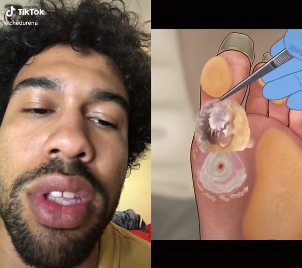 Blackheads Extraction ASMR Comedy Skit