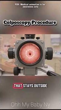 Did you know? A colposcopy is a simple medical procedure that help #colposcopia #3dmedicalanimation