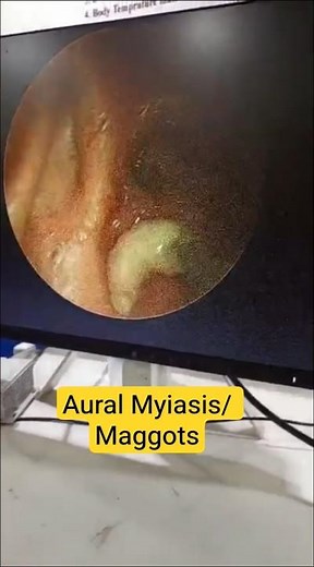 Aural Myiasis/ Maggots removed via 2.7mm zero degree ear endoscope,using Maggots Oil