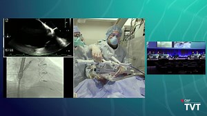 Live Case 15: INNOVALVE TMVR (TWIST EFS) - Mayo Clinic, Rochester MN