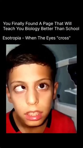 BIOLOGY | MEDICAL | HEALTH on Instagram: "Esotropia is a type of strabismus where one or both eyes turn inward, instead of aligning straight ahead. It can appear in infants, children, or adults and may be constant or come and go. When the eyes aren’t aligned, the brain may start ignoring input from one eye, which can lead to blurred vision, double vision, or amblyopia (lazy eye) if left untreated. Common causes include farsightedness (hyperopia), problems with eye muscles or nerves, genetics, or
