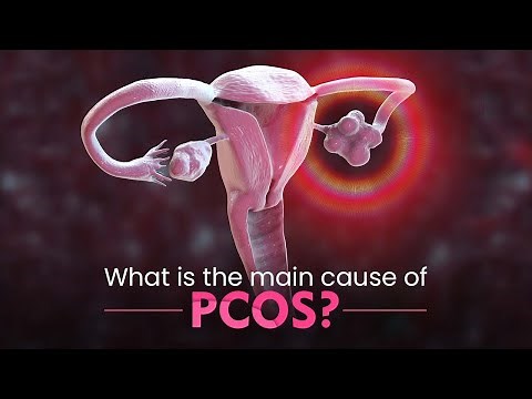 What is the main cause of PCOS?