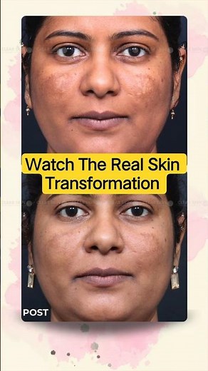 Tired of Skin Problems? Watch This Real Transformation That Will Inspire You! | Clear Skin Clinic