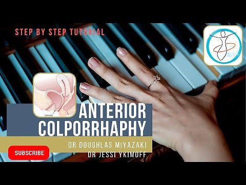 Anterior Colporrhaphy | Cystocoele repair | step wise demonstration