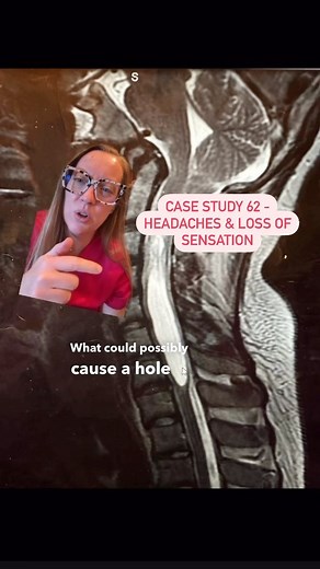 59K views · 811 reactions | Case study 62 - 25yo female presents with headaches and loss of sensation in her hands. What do you think this is? Stay tuned tomorrow and I’ll explain the whole case! #neurosurgery #casestudy#sundaycasestudy #ladyspinedoc #neckpain #headaches #cervicalspine #healthcareworker #hospital #surgery #neurosurgeon #medicalschool #medstudent #medicalstudent #nursing #pastudent #paschool #nursingschool #learnonreels | Dr. Betsy Grunch - Ladyspinedoc | Facebook