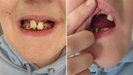 Bride-to-be's fundraiser after bulimia and pregnancies left her teeth crumbling