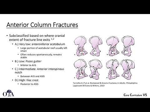 Radiographic evaluation of acetabulum fractures 2 (classification and elementary types) - OTA CCv5
