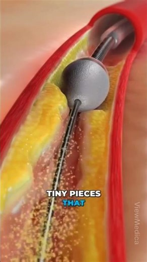 Rotablation -High risk complex angioplasty