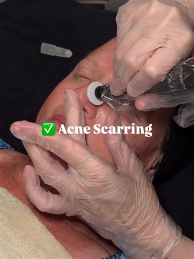 Who is Microchanneling good for? 👇 ✔️Fine lines ✔️Texture & visible pores ✔️Acne scarring ✔️Dull, tired skin @microchanneling is a minimally invasive treatment designed to stimulate collagen, improve skin texture, and restore a healthy glow — with minimal downtime. 🙌 @essential_therapies @procelltherapies #masteresthetician #skincare #esthetician #facials #TheSkinGames