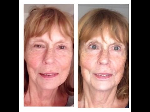 Microcurrent Facelift and the eyes: what you can expect after a series of treatments