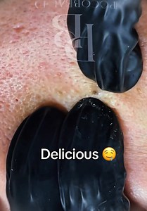 Satisfying Blackhead Extraction Videos