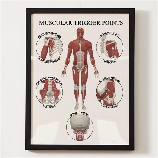 Muscular Trigger Point Poster | Chiropractic Anatomy Poster - Etsy