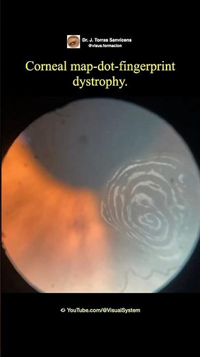 Corneal map-dot-fingerprint dystrophy.