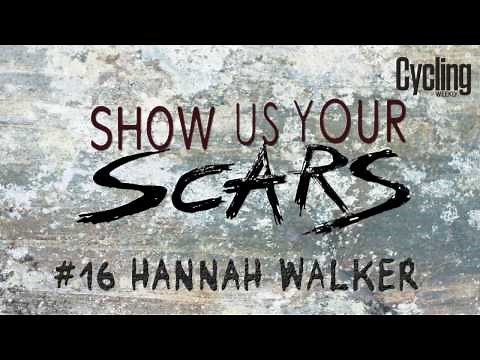 Show us your Scars: Hannah Walker | Cycling Weekly
