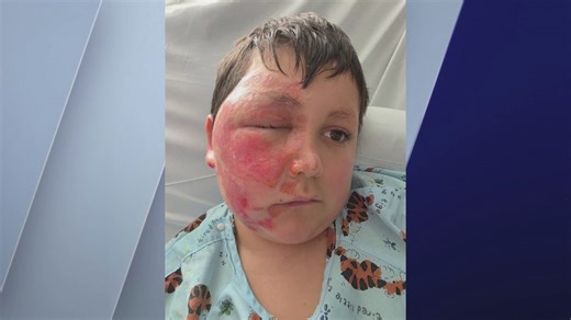 TikTok trend leaves 9-year-old boy with severe burns from microwaved 'NeeDoh' toy