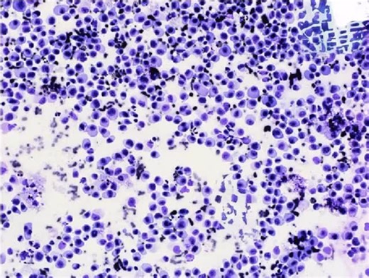 37 reactions | Image-1: FNAC smear from the parotid swelling showing...