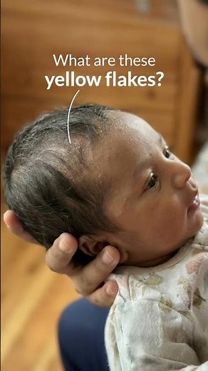 The Ultimate Routine For Flaky Baby Scalp