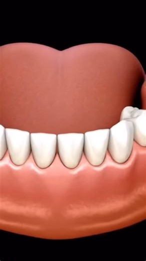 Northland Dental on Instagram: "🦷 If you have missing teeth, partial dentures may be an option for you. This short animated video explains how partial dentures work and how they can help restore your smile. Have questions or concerns? Book an appointment with us to explore your options we’re happy to help! 519-455-2551 #PartialDentures #MissingTeeth #DentalEducation #SmileRestoration"