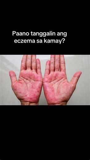 Herbal Cream: The Ultimate Solution for Skin Problems