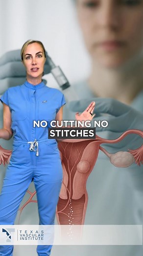 Nervous about UFE? Here’s exactly what to expect — no guessing, no fluff. You arrive at the clinic. You’ll be awake but completely relaxed with light sedation, no general anesthesia. We numb your wrist or groin, then insert a thin catheter to reach the arteries feeding your fibroids. Tiny particles are released to block blood flow, with no cutting and no stitches. The fibroids shrink naturally over time. Afterward, you’ll rest for a few hours, may feel some mild cramping, and then head home the 