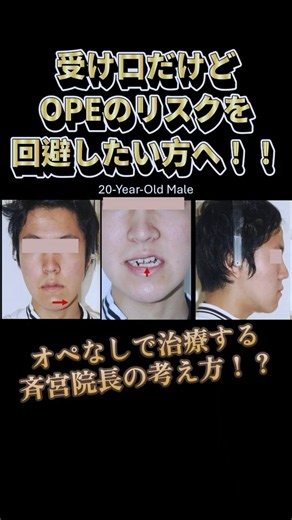 受け口改善!!オペのリスク回避したい方へ!!#歯列矯正 #歯医者 #神宮前矯正歯科 #アイステーション#受け口