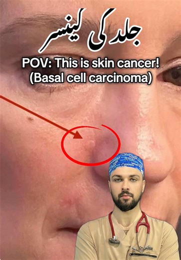 Understanding Basal Cell Carcinoma: Symptoms and Treatment