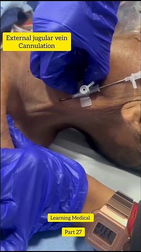 EJV cannulations | external jugular vein cannulations