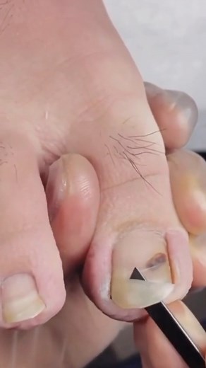 Super long nail. #SelfCarePedicure #PedicureLove #FootCareSelfLove #RelaxationMode #PamperYourFeet #MindfulPedicure #WellnessWednesday #SelfCareSunday #BeautyAndTranquility #EmpoweredSelfCare #HealingVibesPedicure #SoulfulSelfCare #PedicureBliss #CalmingSelfCare #FeetFirstSelfCare #NourishYourSoul #PedicureTherapy #HolisticSelfCare #GlowingFeetHappyHeart #TranquilPedicureMoments | The Pedicure Queen