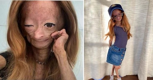 The heroism of Adalia Rose Williams: YouTuber with rare Benjamin Button disease dead at 15