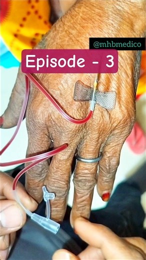 Elderly Patients mein IV fail? Try this Scalp Vein Trick! 💉 #NursingSkills #IVAccess