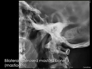 CASE 704 Bilateral sclerosed mastoid bone mastoiditis