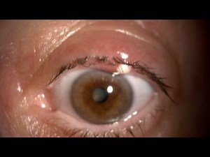 Stye and chalazion