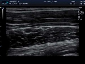 Nerve gliding in ultrasound